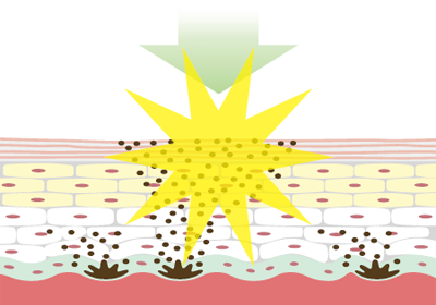 ライムライトの光治療 1