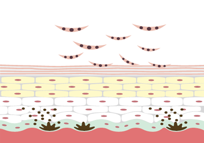 ライムライトの光治療 2