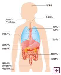 全身のがん